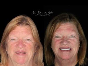 Woman's face before and after dental procedure