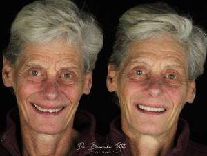 Man's face before and after dental procedure
