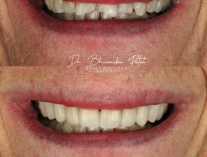 Teeth before and after dental procedure