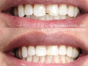 Teeth before and after dental procedure
