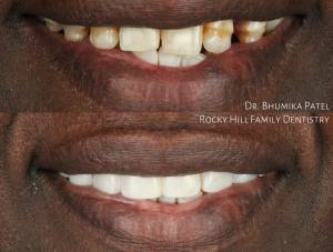 Teeth before and after dental procedure