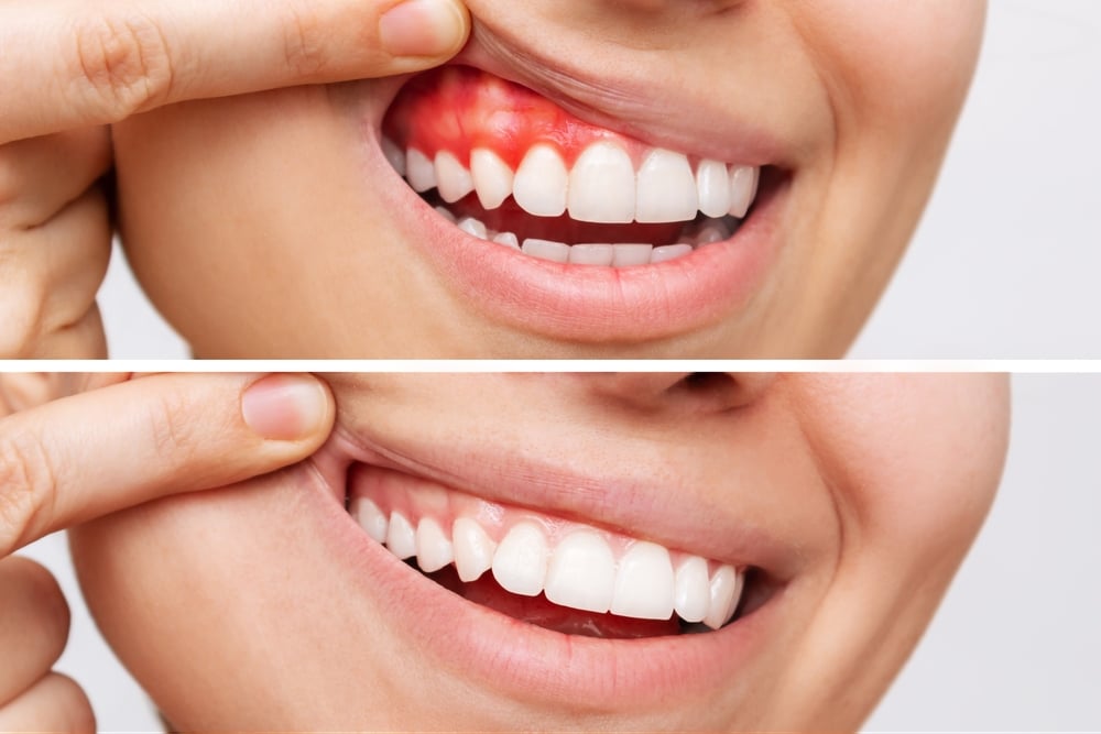 woman showing her gums
